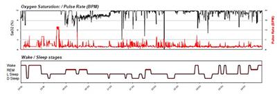 Sleep Monitoring Using WatchPAT Device to Predict Recurrence of Major Depression in Patients at High Risk for Major Depression Disorder Recurrence: A Case Report